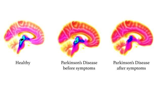 帕金森症大脑早期预警 科学家找到关键线索