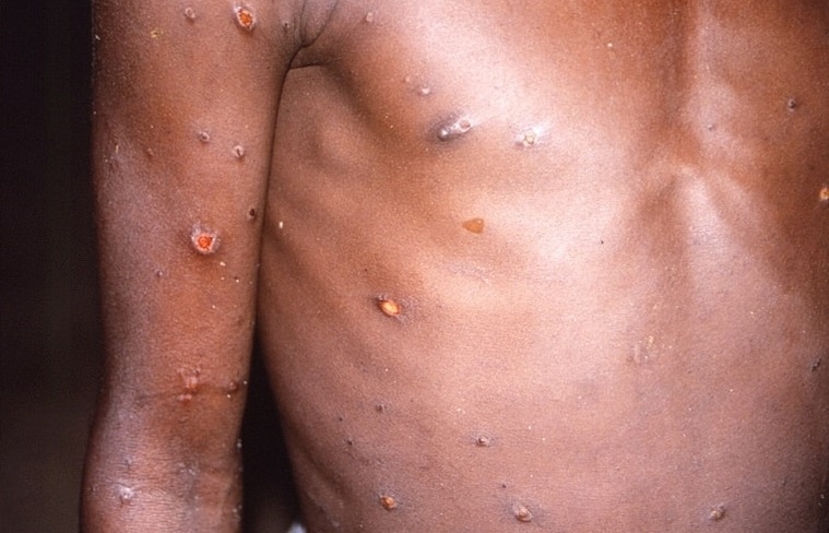 感染猴痘的病患，皮肤会长出类似水痘的脓疮