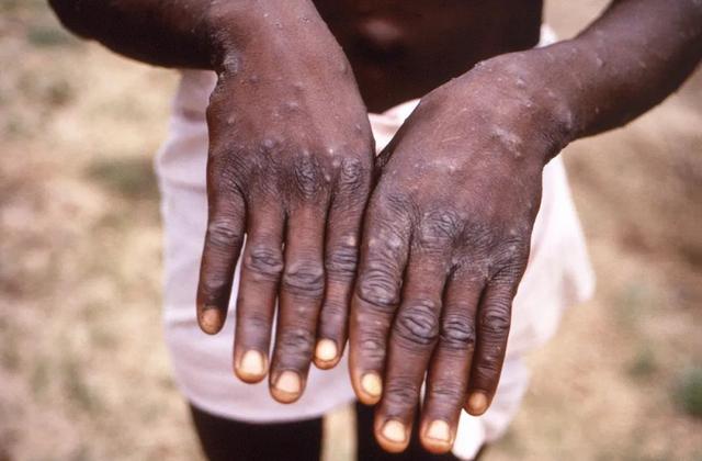 非洲一名猴痘患者展示其手部