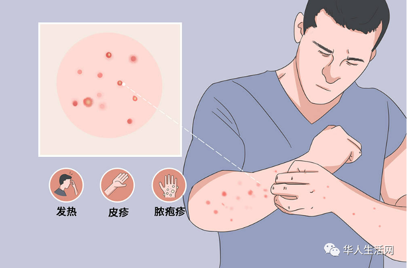 猴痘的正常初始症状包括高烧、淋巴结肿大和水疱样皮疹